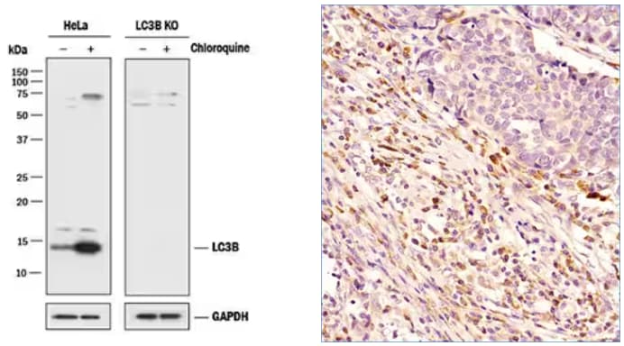 WB of LC3B expression under various conditions and IHC analysis of human breast cancer treated with Beclin 1 antibody.