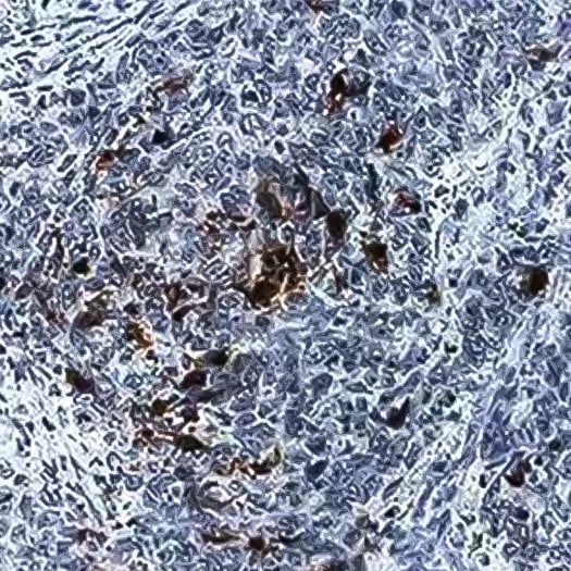 Immunohistochemical analyis of Caspase-3 (active) expression in human colon cancer tissue with tissue stained using DAB (brown) 