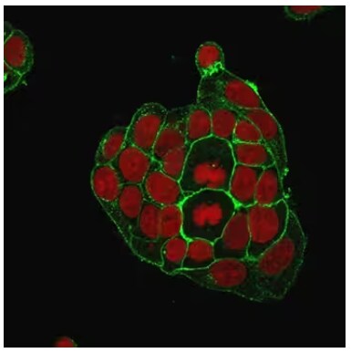 Immunofluorescence staining of MCF-7 breast cancer cells using GluT1 antibody.