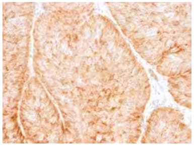 Immunohistochemical staining of GluT1 antibody in human bladder carcinoma.