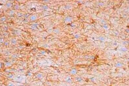 Immunohistochemical analysis of GFAP antibody expression in human brain with DAB staining (brown) and counterstaining with hemat