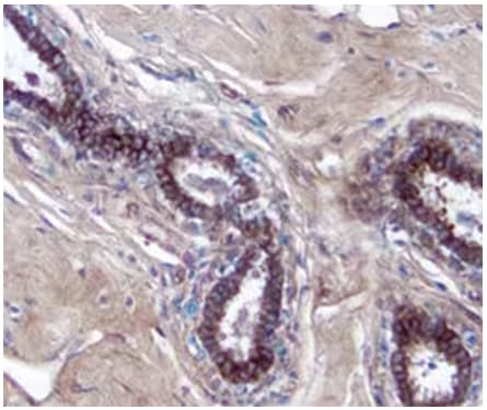 IHC staining of MICA expression in human breast cancer tissue.