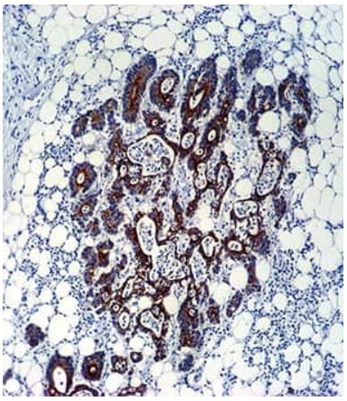 TGF-beta 2 expression in colon carcinoma IHC