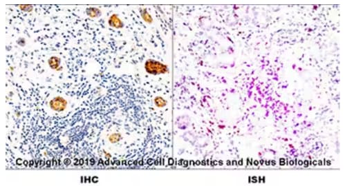 Dual RNAscope ISH-IHC of HLA-DR expression in human metastatic tonsil.
