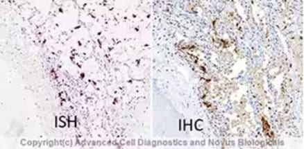 Dual RNAscope ISH-IHC of SARS-CoV-2 infected human lung tissue.