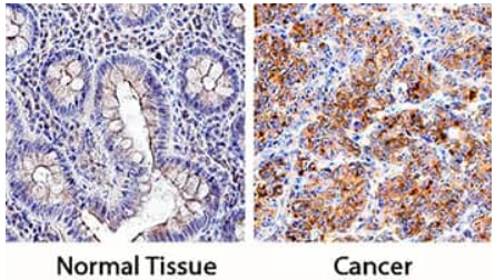 IHC staining of PD-L1 expression in normal and cancerous human colon tissues.
