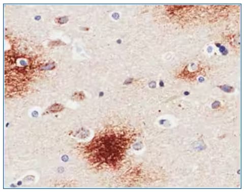 IHC staining of Alzheimer's disease hippocampus tissue with Amyloid Beta antibody.