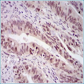 Example of Chromogenic IHC Detection: Survivin in Human Rectal Cancer