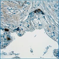 IHC staining of Angiopoietin-1 in human prostate cancer tissue