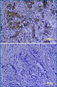 IHC staining of VEGF in human breast cancer tissue