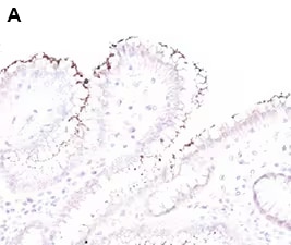 Immunohistochemistry analysis of Helicobacter pylori expression in human stomach tissue