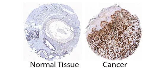 Immunohistochemistry analysis of HSP47 in normal and cancerous breast tissue.