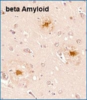 IHC staining of beta Amyloid in human hippocampus of Alzheimer's disease affected brain