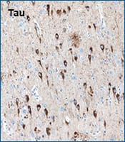 IHC staining of Tau in human Alzheimer's diseased brain