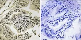 Immunohistochemistry image of PERK expression in human prostate carcinoma