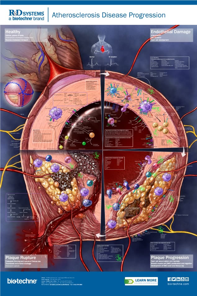 Atherosclerosis Disease Progression Cell Markers