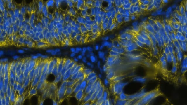 Detection of Cadherin in Human Colon Cancer via Multiplex Immunofluorescence staining on COMET™