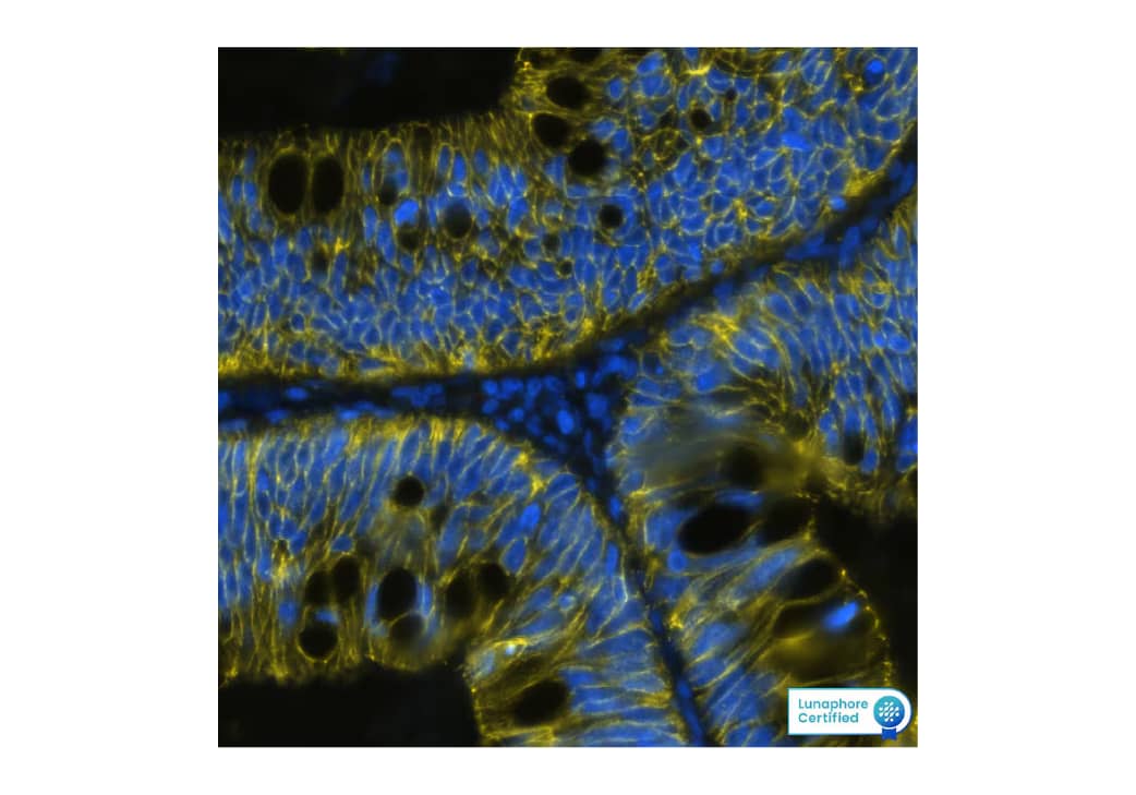 Detection of Cadherin in Human Colon Cancer via Multiplex Immunofluorescence staining on COMET™