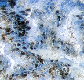 Akt2 antibody in Human Pancreatic Cancer Tissue by Immunohistochemistry (IHC-P).