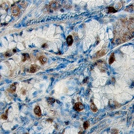 Phospho-Axl (Y779) antibody in Human Stomach Cancer Tissue by Immunohistochemistry (IHC-P).