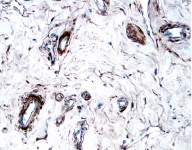 PDGF R beta  antibody in Human Breast Cancer Tissue by Immunohistochemistry (IHC-P).