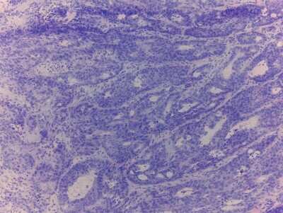Hematoxylin & Eosin Stain: Colon Tissue Slides (Tumor)- Frozen [NBP2-77635]