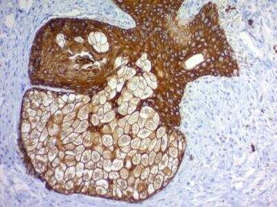 Immunohistochemistry-Paraffin: Cytokeratin, pan Antibody (PAN-CK (Cocktail)) - Azide and BSA Free [NBP2-76425]