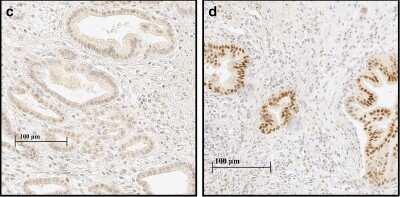 Immunohistological Detection of HIF-1 alpha in PDAC and Adjacent Normal Pancreatic Tissue