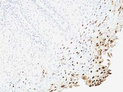 Immunohistochemistry-Paraffin: HPV16 Antibody (SPM257) - Azide and BSA Free [NBP3-08551]