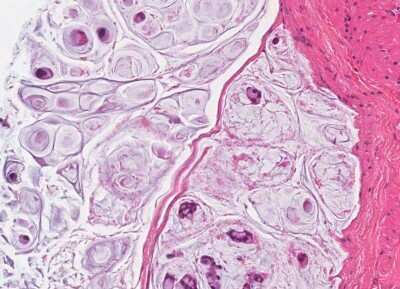 Immunohistochemistry-Paraffin: Human Bladder Tissue MicroArray (Cancer) [NBP3-11846]