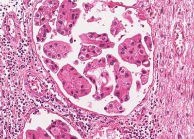 Immunohistochemistry-Paraffin: Human Bladder Tissue MicroArray (Cancer) [NBP3-11846]