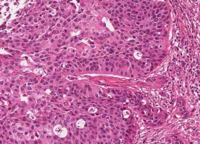 Immunohistochemistry-Paraffin: Human Bladder Tissue MicroArray (Cancer) [NBP3-11846]