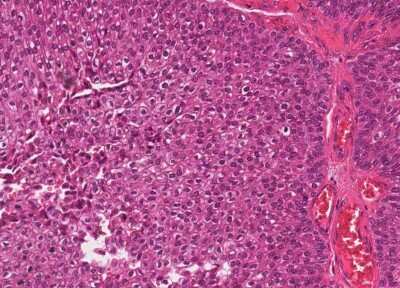 Immunohistochemistry-Paraffin: Human Bladder Tissue MicroArray (Cancer) [NBP3-11846]