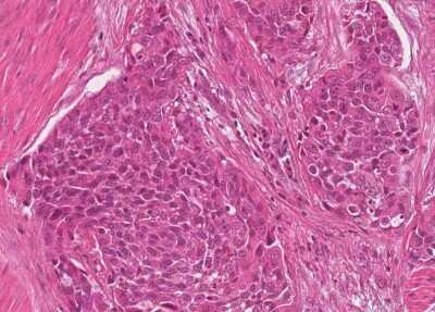 Immunohistochemistry-Paraffin: Human Bladder Tissue MicroArray (Cancer) [NBP3-11846]