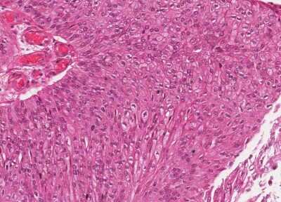 Immunohistochemistry-Paraffin: Human Bladder Tissue MicroArray (Cancer) [NBP3-11846]