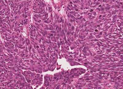 Immunohistochemistry-Paraffin: Human Bladder Tissue MicroArray (Cancer) [NBP3-11846]