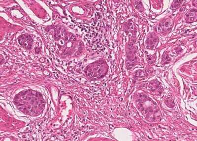 Immunohistochemistry-Paraffin: Human Bladder Tissue MicroArray (Cancer) [NBP3-11846]