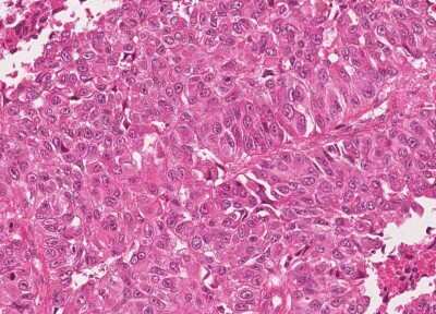 Immunohistochemistry-Paraffin: Human Bladder Tissue MicroArray (Cancer) [NBP3-11846]