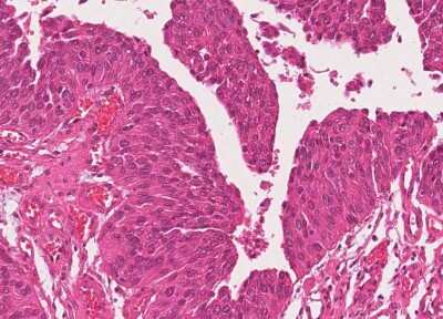 Immunohistochemistry-Paraffin: Human Bladder Tissue MicroArray (Cancer) [NBP3-11846]