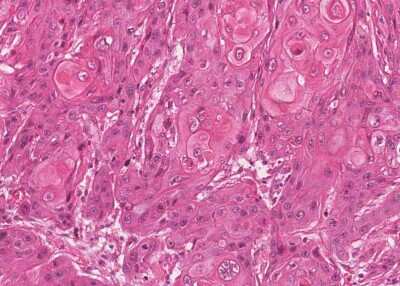 Immunohistochemistry-Paraffin: Human Bladder Tissue MicroArray (Cancer) [NBP3-11846]