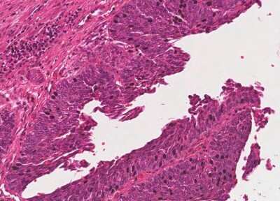 Immunohistochemistry-Paraffin: Human Bladder Tissue MicroArray (Cancer) [NBP3-11846]
