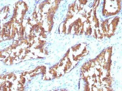 Immunohistochemistry-Paraffin: Isocitrate Dehydrogenase 1/IDH1 Antibody (IDH1/1152) - IHC-Prediluted [NBP2-48302]