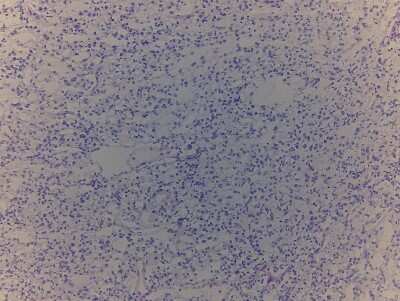 Hematoxylin & Eosin Stain: Kidney Tissue Slides (Tumor)- Frozen [NBP2-77637]
