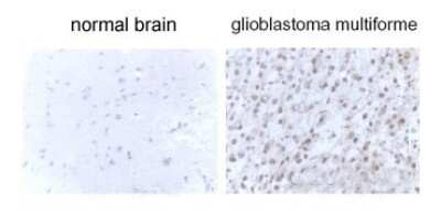 Immunohistochemical Staining of LC3B in Glioblastoma Multiform Tissue