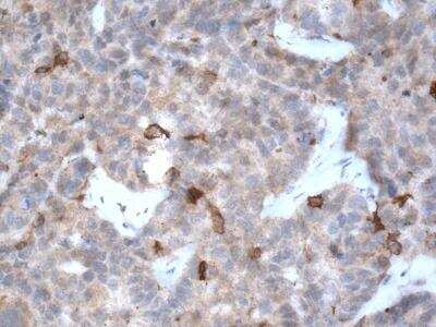 Immunohistochemical Staining of LC3B in Paraffin Embedded Ovarian Cancer Tissue
