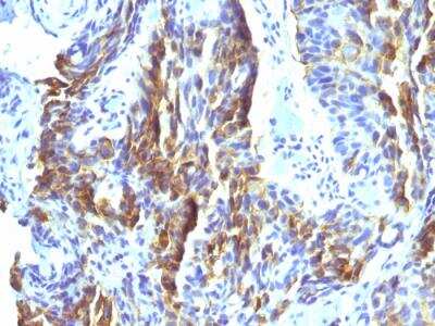 Immunohistochemistry-Paraffin: Melanoma Associated Antigen (KBA.62) Antibody (KBA.62) - IHC-Prediluted [NBP2-48210]