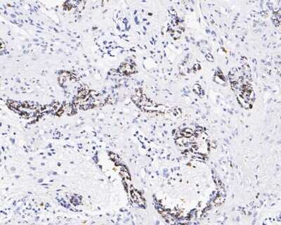 Immunohistochemistry-Paraffin: Melanoma HMB45 + MART1 + Tyrosinase Antibody (SC56-02) [NBP2-67589]