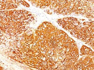 Immunohistochemistry-Paraffin: Melanoma Marker (MART-1 + Tyrosinase + gp100) Antibody (A103 + T311 + HMB45) [NBP2-34339]