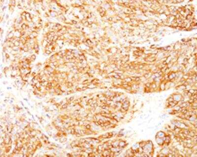 Immunohistochemistry-Paraffin: Melanoma Marker (MART-1 + gp100) Antibody (DT101+ BC199 + HMB45) [NBP2-34341]