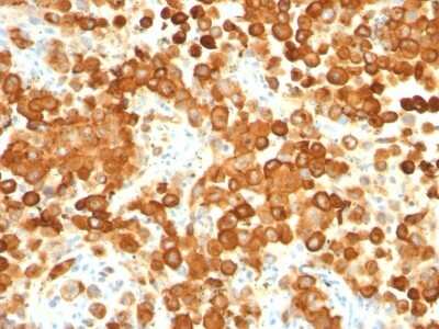 Immunohistochemistry-Paraffin: PMEL17/SILV Antibody (HMB45 + PMEL/783) [NBP2-44523]